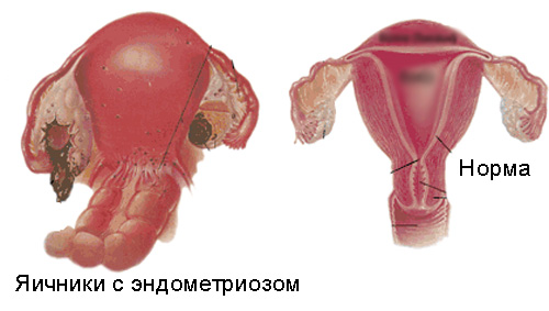 схема эндометриоза левого яичника у женщины и здорового