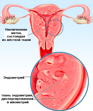 беременность при аденомиозе матки 