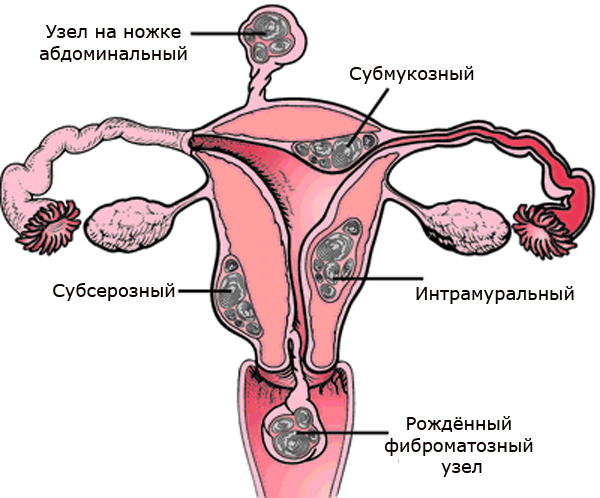 интерстициально субсерозная миома тела матки