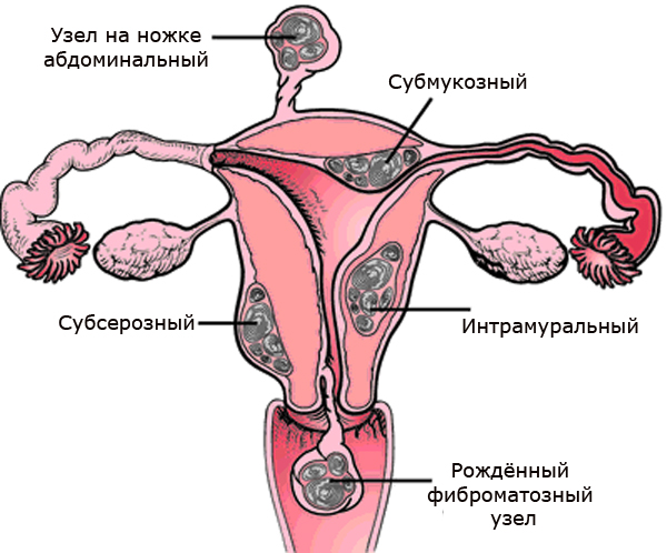 может ли миома перерасти в рак 