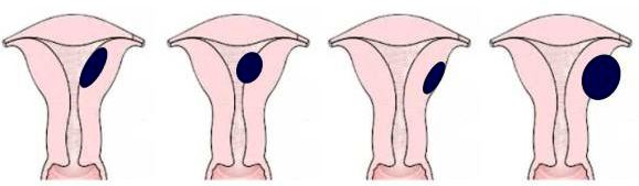 4 стадии развития очагового аденомиоза