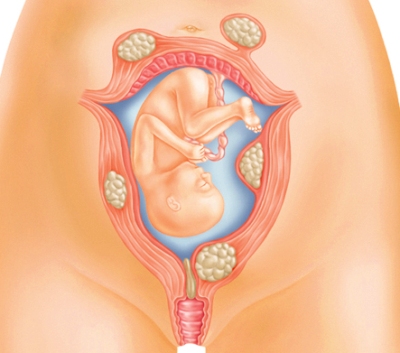 От чего растет миома матки при беременности thumbnail