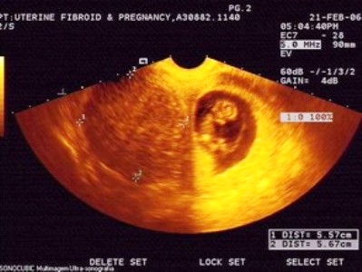 Может ли при беременности появиться миома thumbnail