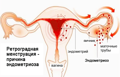 Схема ретроградной менструации - причины эндометриоза