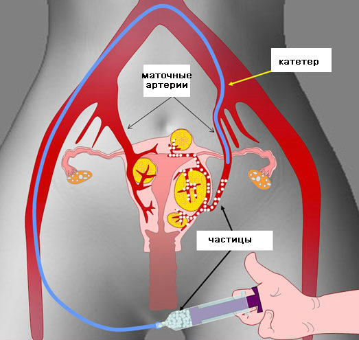 эмболизация маточных артерий при миоме матки