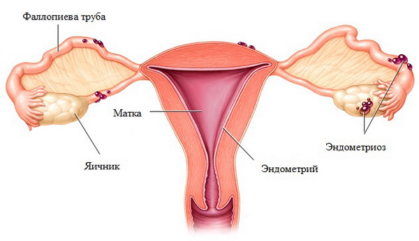 возможна ли беременность при эндометриозе яичников