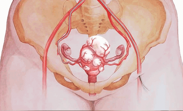 при каких размерах миомы матки делают операцию