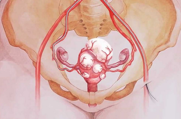 беременность после удаления миомы