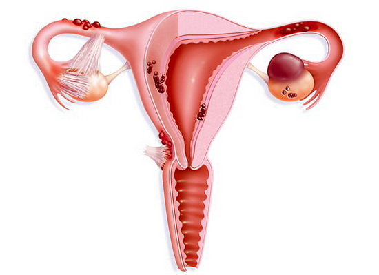 эндометриоз шейки матки лечение