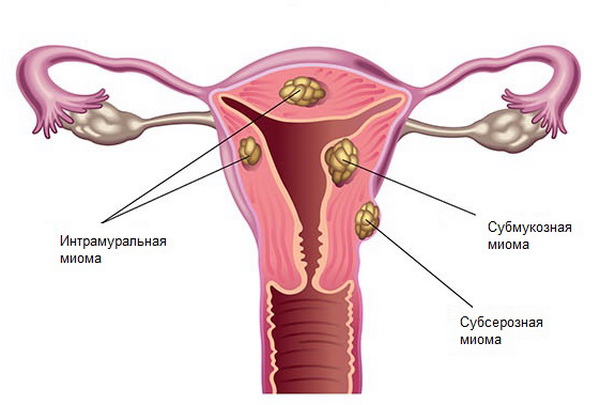 субсерозная и интрамуральная миома матки и беременность