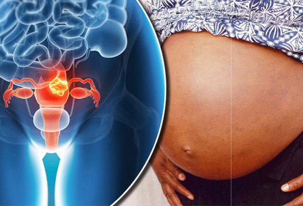 Опасна ли субсерозная миома матки для беременности