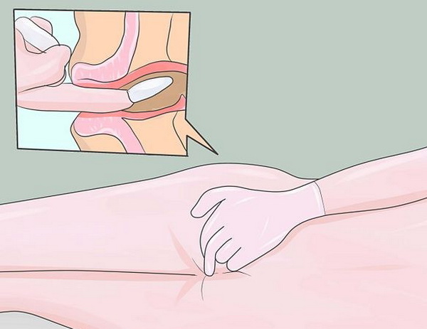 Как вставить вагинальный суппозиторий
