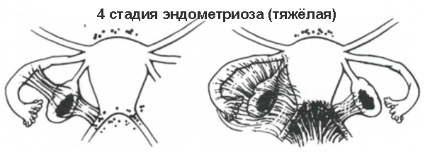 Беременность на фоне эндометриоза форум