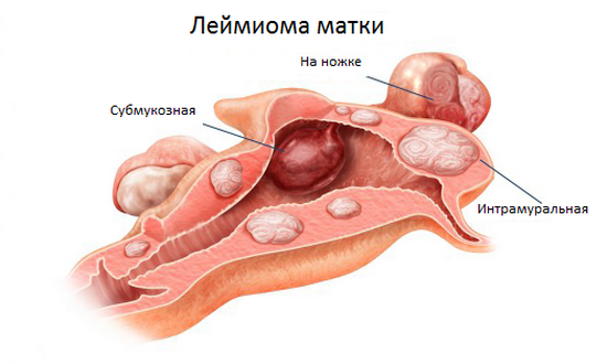 интрамуральная лейомиома матки показания к операции
