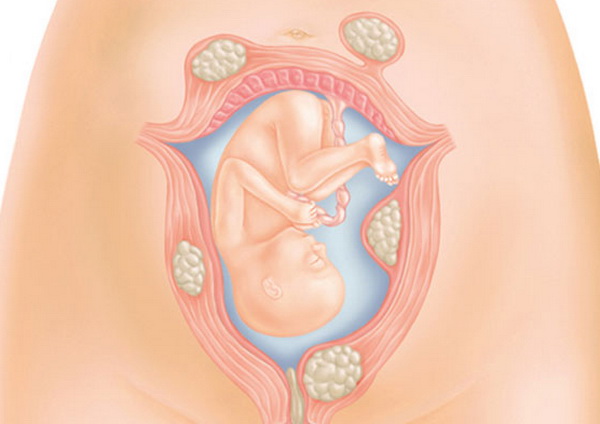Миома матки или беременность 10