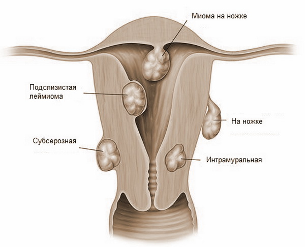 Подслизистая лейомиома матки что это. Субмукозная миома матки макропрепарат. Субсерозная миома на ножке. Лейомиома матки подслизистая миома матки. Многоузловая фибромиома матки.