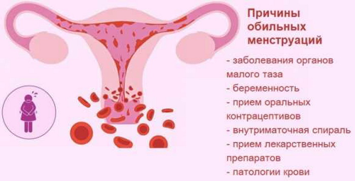 Месячные 3 день сильный. Причины обильных месячных. Менструальное кровотечение.